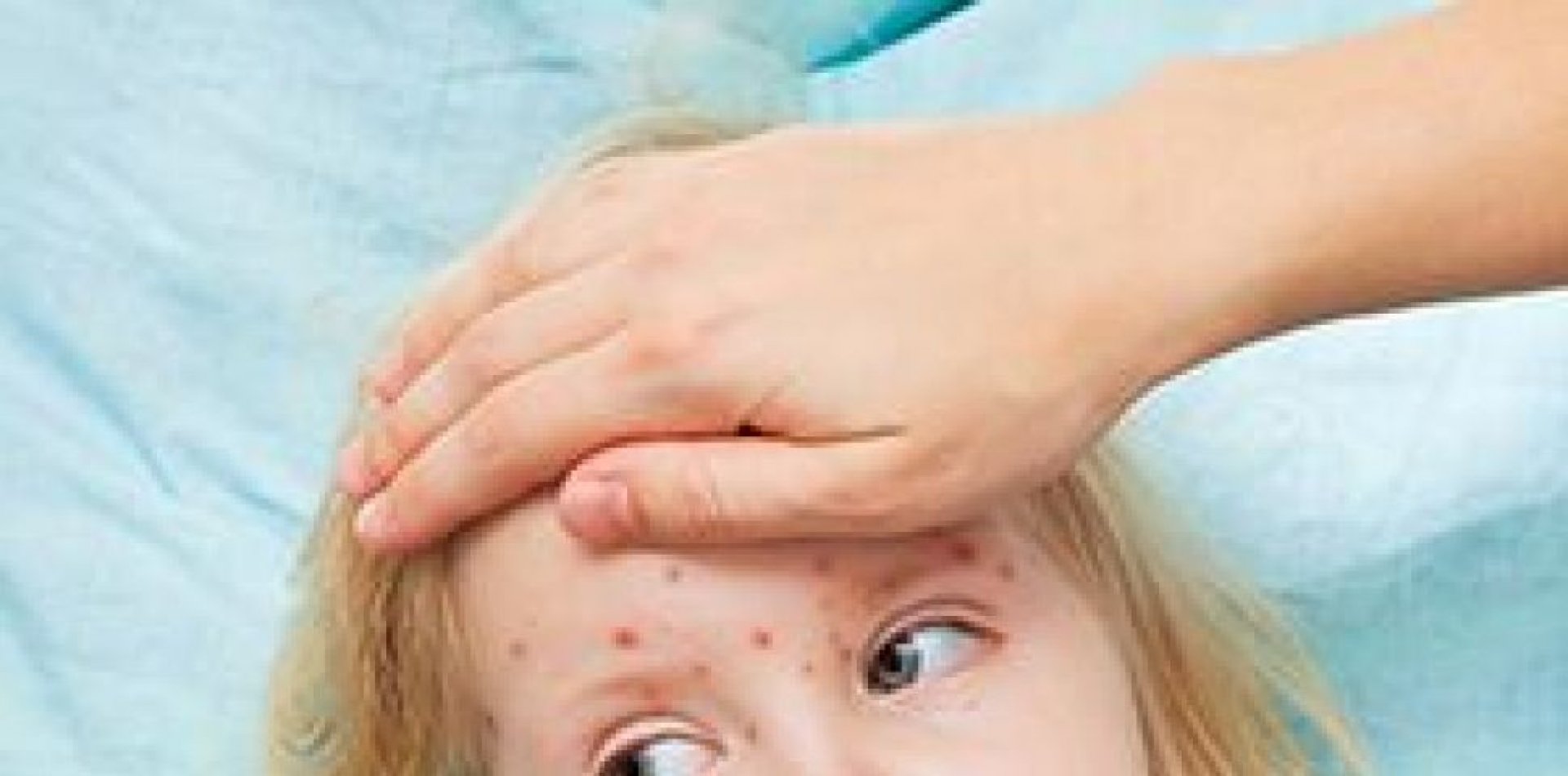 Над 3100 заболели от варицела за по-малко от месец - E-Burgas.com