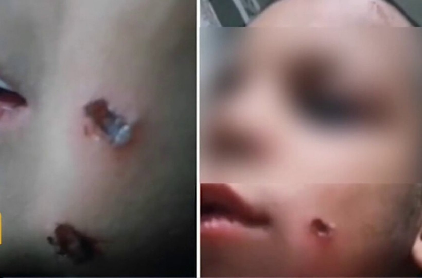 Разследват изгаряния от цигара по лицето на малко момче  - E-Burgas.com