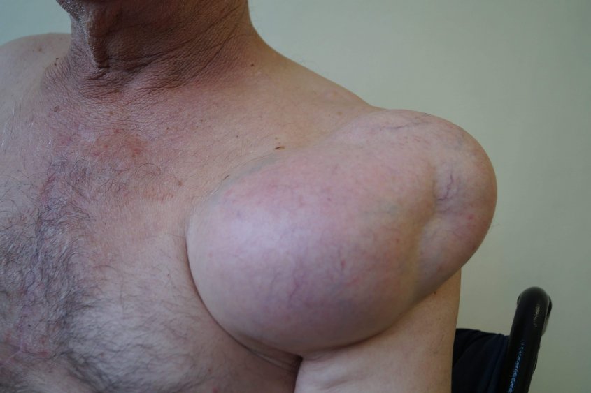Отстраниха гигантски тумор от рамото на пациент в Бургас (снимки) - E-Burgas.com